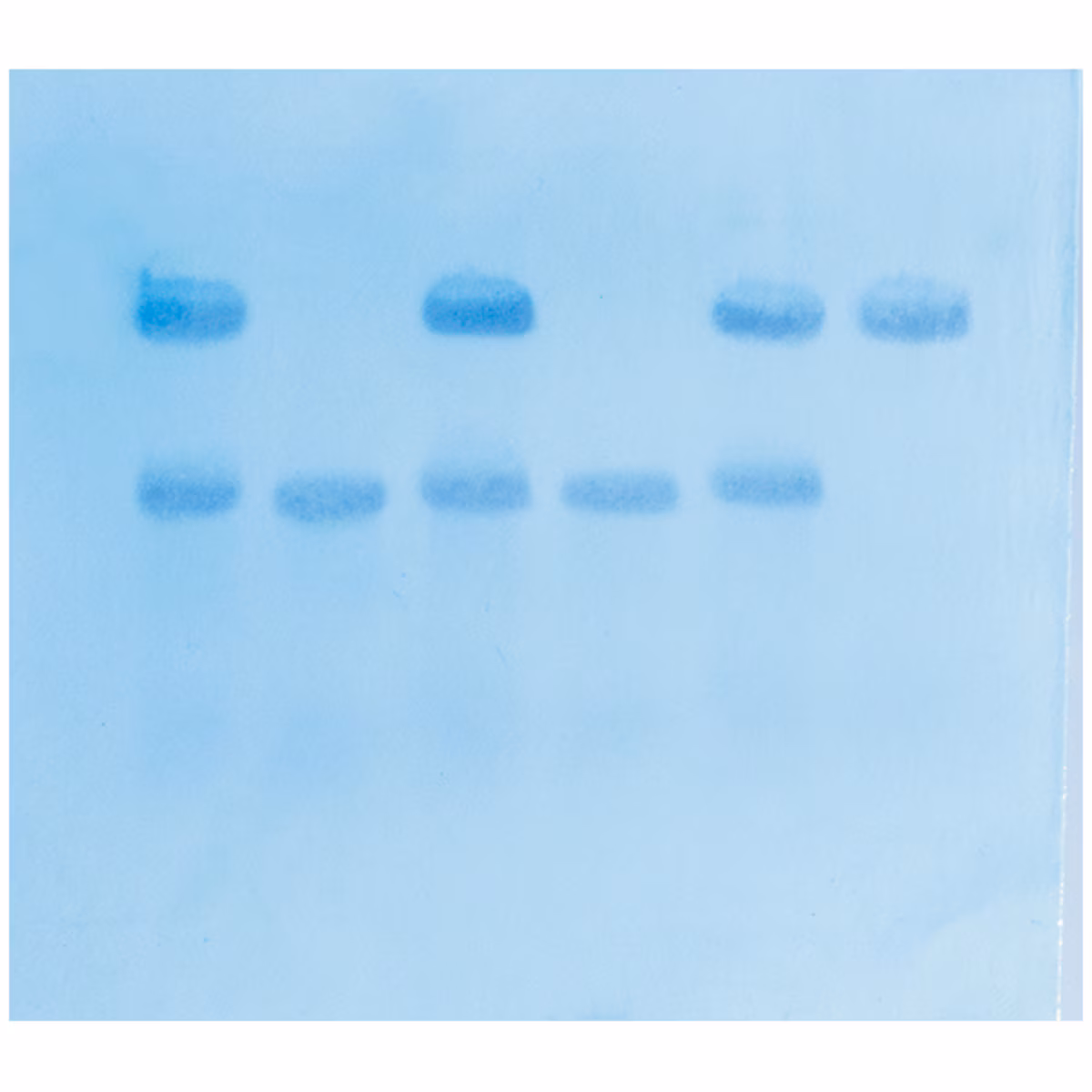 In Search of the Sickle Cell Gene by Southern Blot